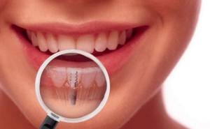 Зубная имплантация как вид стоматологической помощи